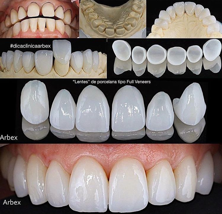 Porcelain, E-max, or Zirconia Veneers: Which Is Best for Your Smile?