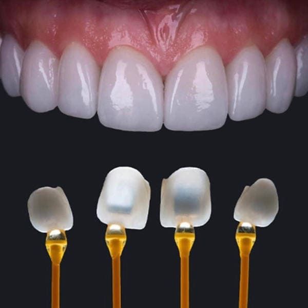 Veneers