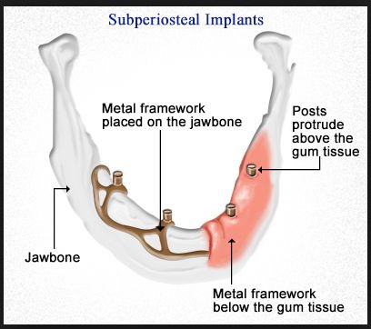 Subperiosteal Implants