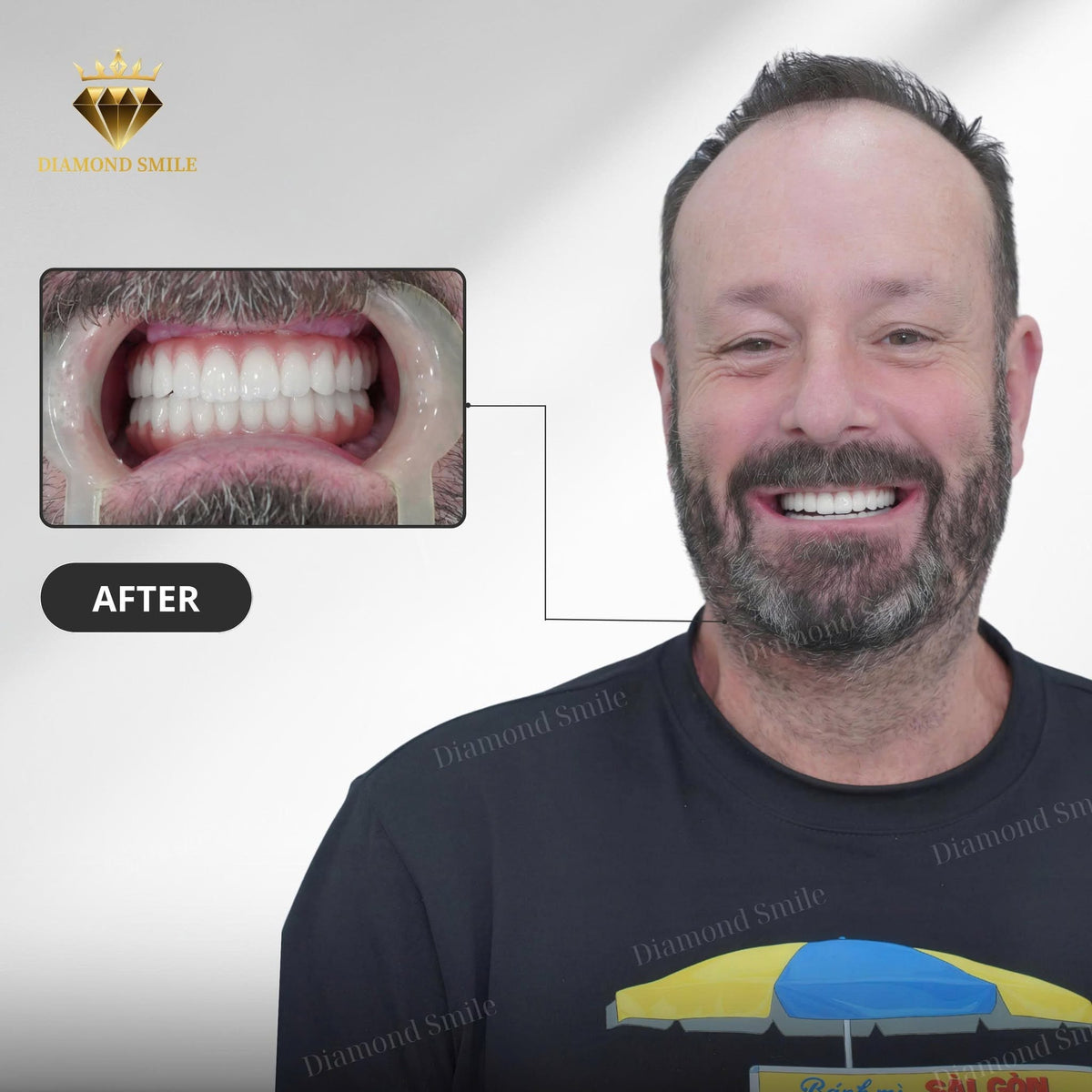 Dental implants