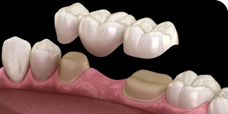 Dental Bridge