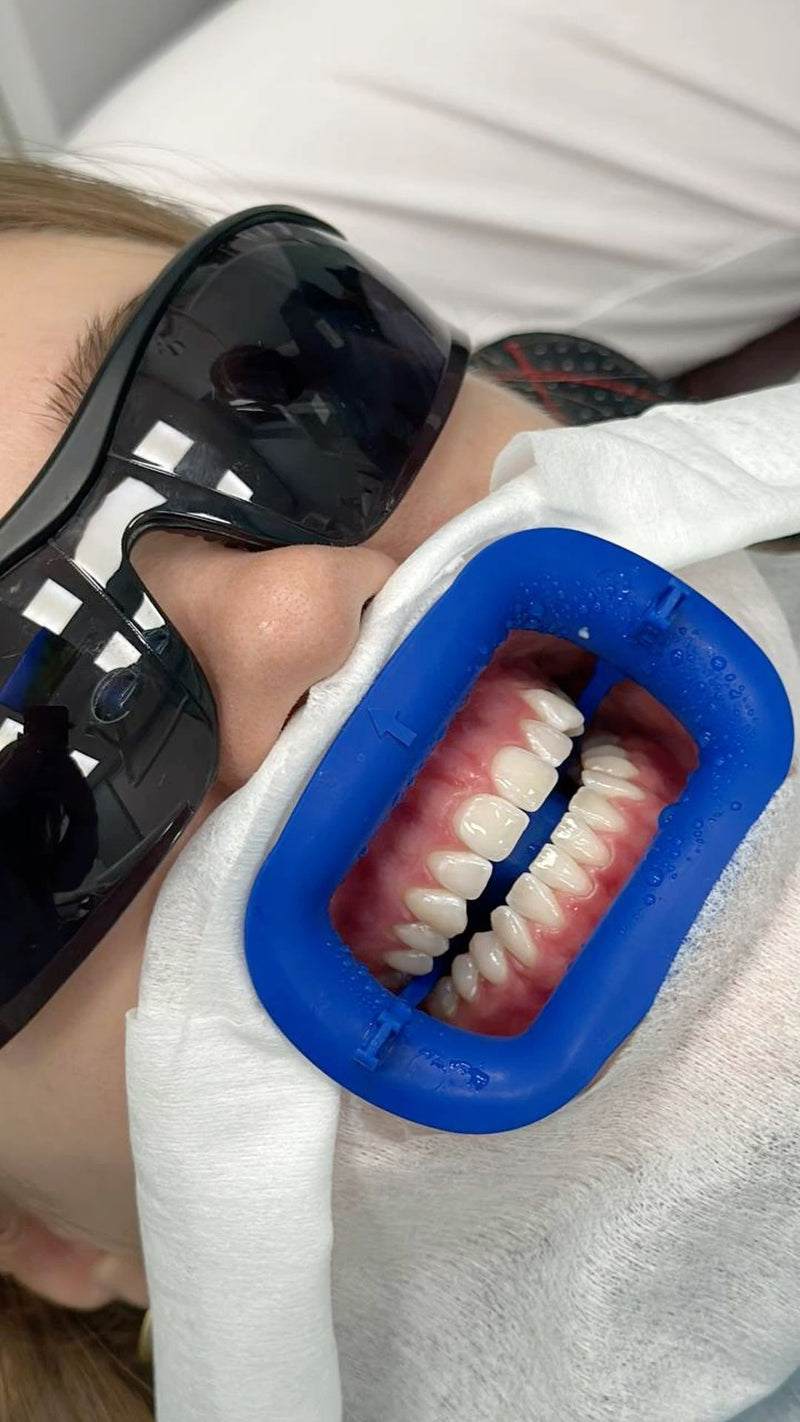 Teeth Whitening